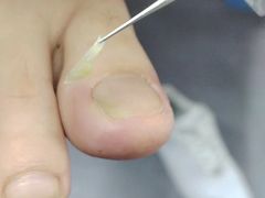 -祖传修脚甲沟炎灰指甲鸡眼
