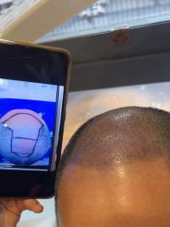 -碧莲盛·不剃发植发