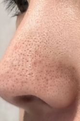 -成都苗方清颜专业祛痘