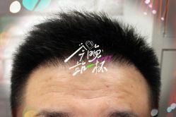 -大麦微针植发全国连锁