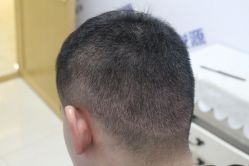 -大麦微针植发丨全国连锁