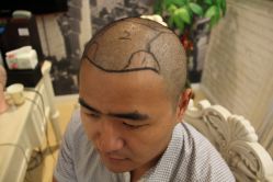 点击看大图 -大麦微针植发丨全国连锁