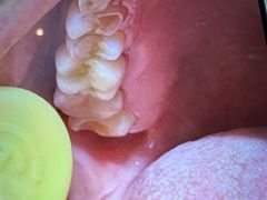 -上海仁爱医院口腔科 · 种植