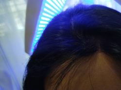 -碧莲盛·不剃发植发