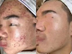 -苗方清颜专业祛痘连锁机构