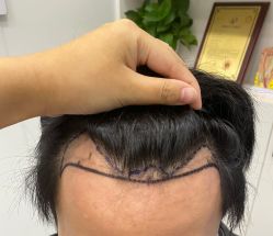 -大麦微针植发全国连锁