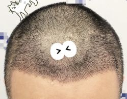 -大麦微针植发全国连锁