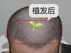 -大麦微针植发全国连锁