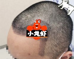 -大麦微针植发全国连锁