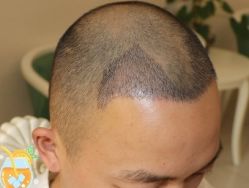 -大麦微针植发丨全国连锁