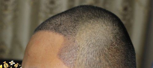 -大麦微针植发丨全国连锁