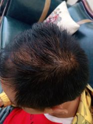 -碧莲盛·不剃发植发