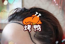 -大麦微针植发全国连锁