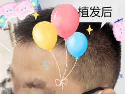 -大麦微针植发全国连锁