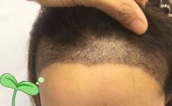 -大麦微针植发丨全国连锁