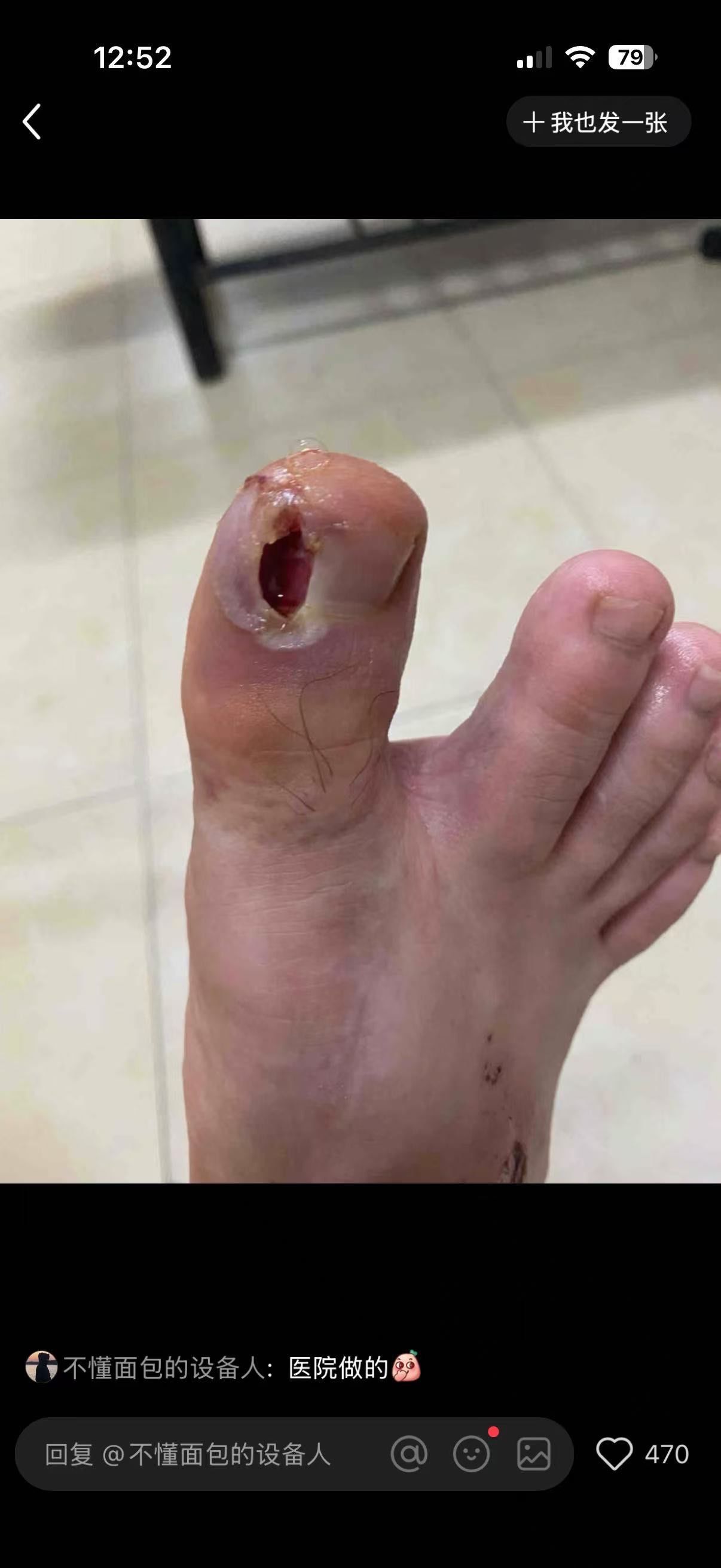 为什么会有甲沟炎 为什么会有甲沟炎