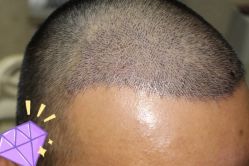 -大麦微针植发丨全国连锁