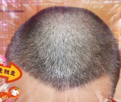 -大麦微针植发全国连锁