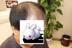 -大麦微针植发丨全国连锁