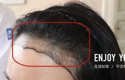 -大麦微针植发全国连锁