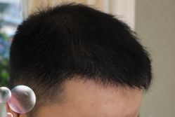 -大麦微针植发丨全国连锁