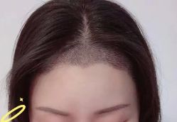 -大麦微针植发丨全国连锁