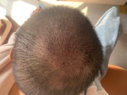 -大麦微针植发丨全国连锁