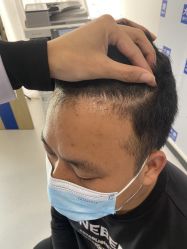 体验后-大麦微针植发全国连锁