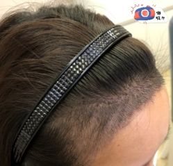 -大麦微针植发丨全国连锁