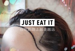 -大麦微针植发全国连锁