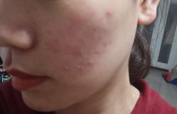-蕾特恩专业祛痘·皮肤管理