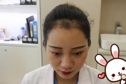 点击看大图 -大麦微针植发丨全国连锁