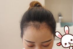 点击看大图 -大麦微针植发丨全国连锁