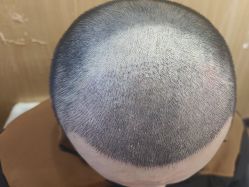 -雍禾植发