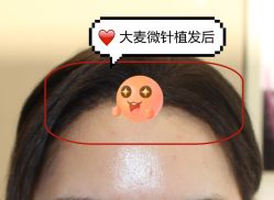 -大麦微针植发全国连锁