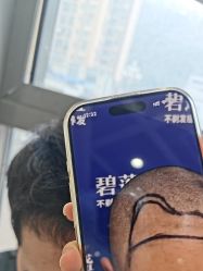 -碧莲盛·不剃发植发