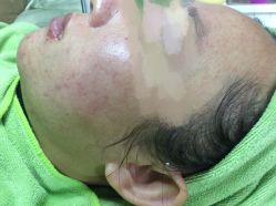 -苗医生草本科技祛痘