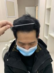 -大麦微针植发丨全国连锁