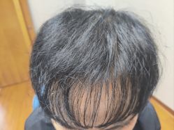 体验后-大麦微针植发全国连锁