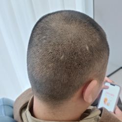 -大麦微针植发丨全国连锁