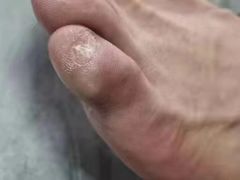 -世龙世家灰指甲鸡眼脚气甲沟炎跖疣护理(通州店)