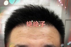 -大麦微针植发全国连锁