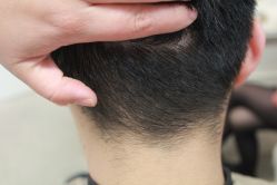 点击看大图 -大麦微针植发丨全国连锁