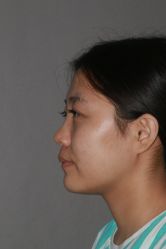 体验前-北京米扬丽格医疗美容·联合丽格鼻整形中心