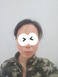 体验前-广州健丽·去眼袋医疗美容机构