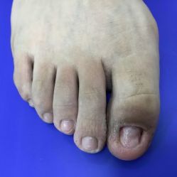 -德哥灰指甲脚气甲沟炎跖疣护理