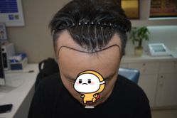 -大麦微针植发全国连锁