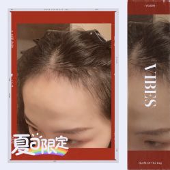 -大麦微针植发全国连锁