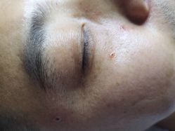 -美人痣全国连锁