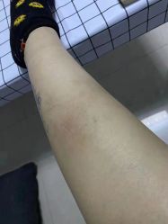 -百年美肤堂祛痦痣祛斑祛疣